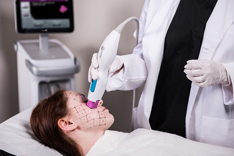 Trẻ hóa da bằng phương pháp Thermage FLX