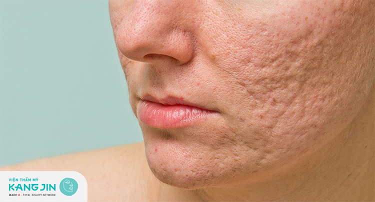 Da mặt bị sẹo rỗ khi thay da để trẻ hóa sai cách