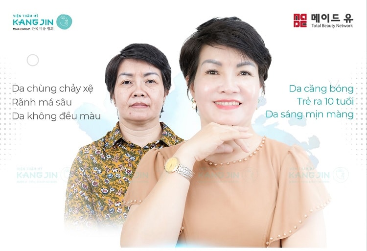 Khách hàng lấy lại làn da căng bóng mịn màng tuổi đôi mươi