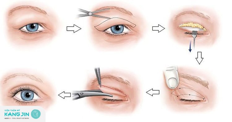 Kỹ thuật cắt mí mắt loại bỏ nhanh chóng phần da chảy xệ