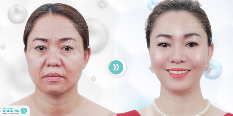 Làn da mặt và cổ thay đổi rõ rệt sau khi trẻ hóa