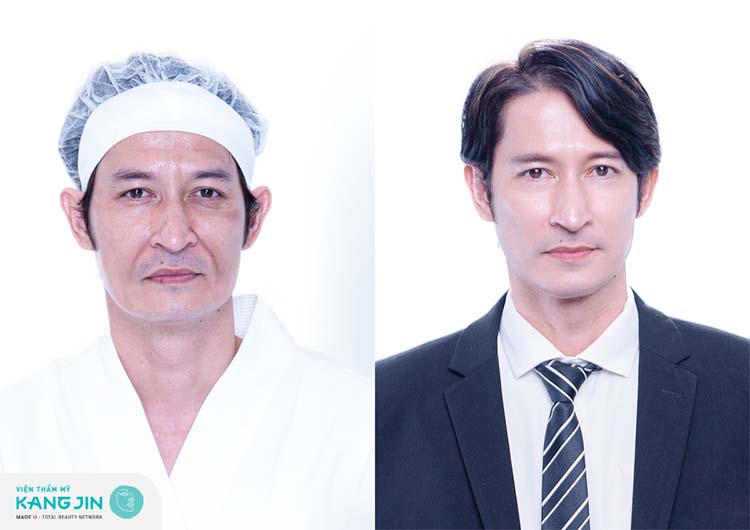 Diễn viên Huy Khánh thay đổi rõ rệt sau khi cấy sợi Collagen Nano Cell X6