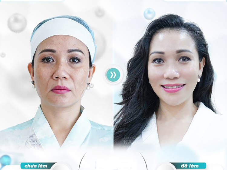 Hiệu quả ngay sau khi thực hiện làm đẹp