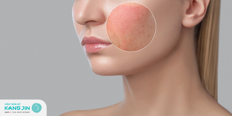 Giảm kích ứng hiệu quả Giảm kích ứng hiệu quả
