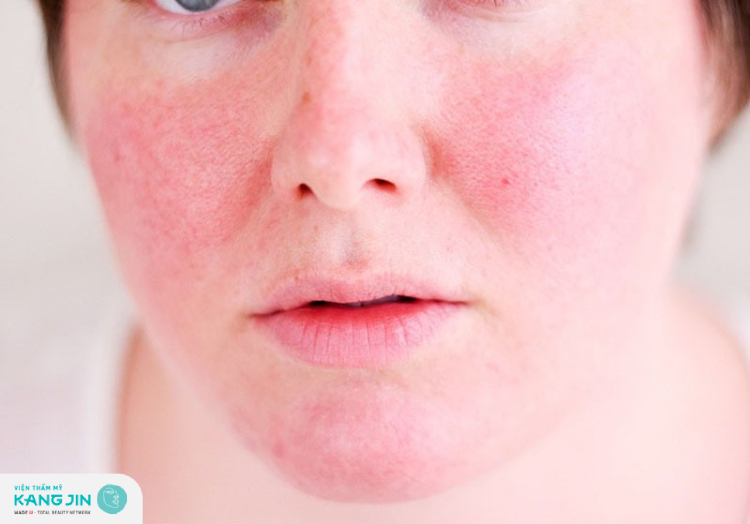 Một số biểu hiện thường gặp sau khi peel da
