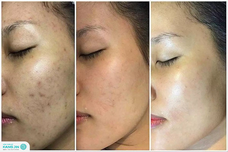 Công dụng của peel da nổi bật là trị mụn, mờ thâm