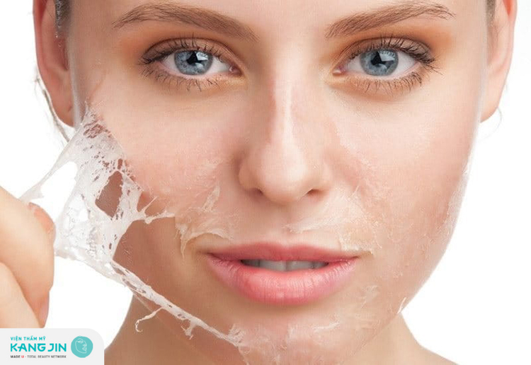 Phương pháp peel da là giải pháp được nhiều người lựa chọn chữa da mặt sần sùi nhiều mụn cám