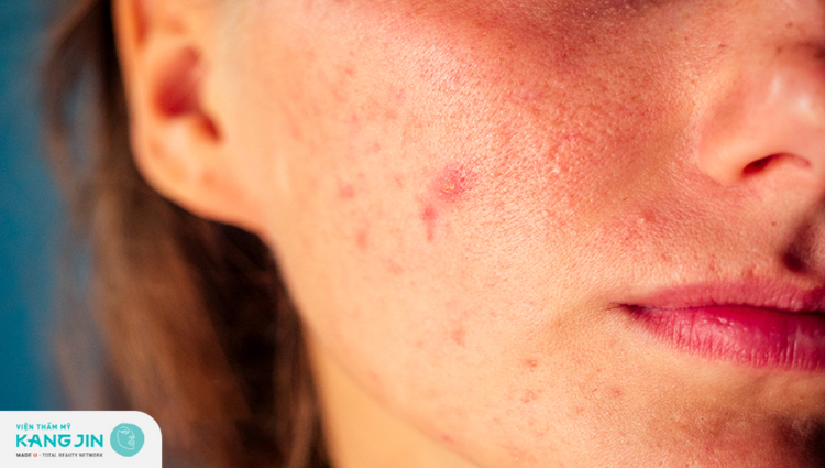 Dị ứng da bị mụn khiến bạn mất tự tin về làn da
