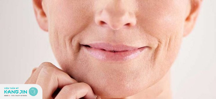 Nếp nhăn quanh miệng xuất hiện do nhiều nguyên nhân