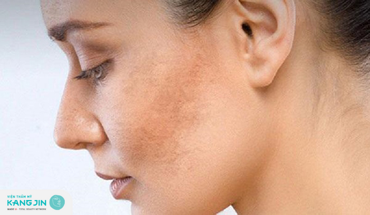 Những vùng da bị thâm nám sạm màu đều có thể điều trị bằng Laser
