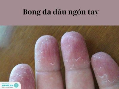 Bong da đầu ngón tay là bị bệnh gì?