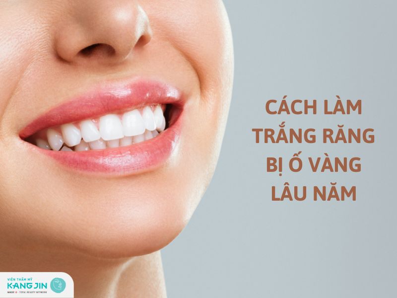 Vì Sao Răng Bị ố Vàng Cách Làm Trắng Răng Hiệu Quả An Toàn 