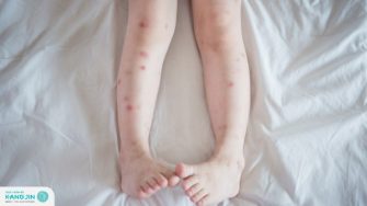 7 cách trị thâm chân hiệu quả   mà bạn không nên bỏ qua