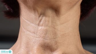 Nguyên nhân và cách chăm sóc da cổ chảy xệ tại nhà