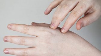 Da tay bị bong tróc do thiếu chất gì? Khắc phục như thế nào?
