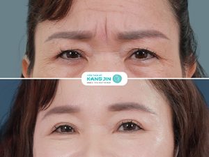 Xóa nhăn ấn đường