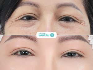 Xóa nhăn vùng mắt
