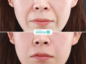 Xóa rãnh cười