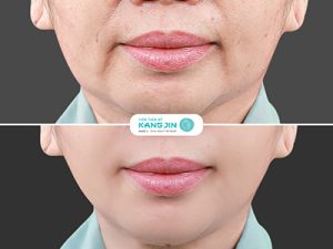 Xóa râu rồng