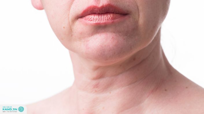 ngăn ngừa nếp nhăn ở cổ