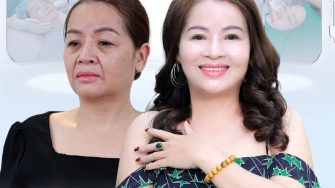 Tất tần tật về Căng da mặt cần phải biết, Bí kíp “vàng” giúp Căng da mặt hiệu quả