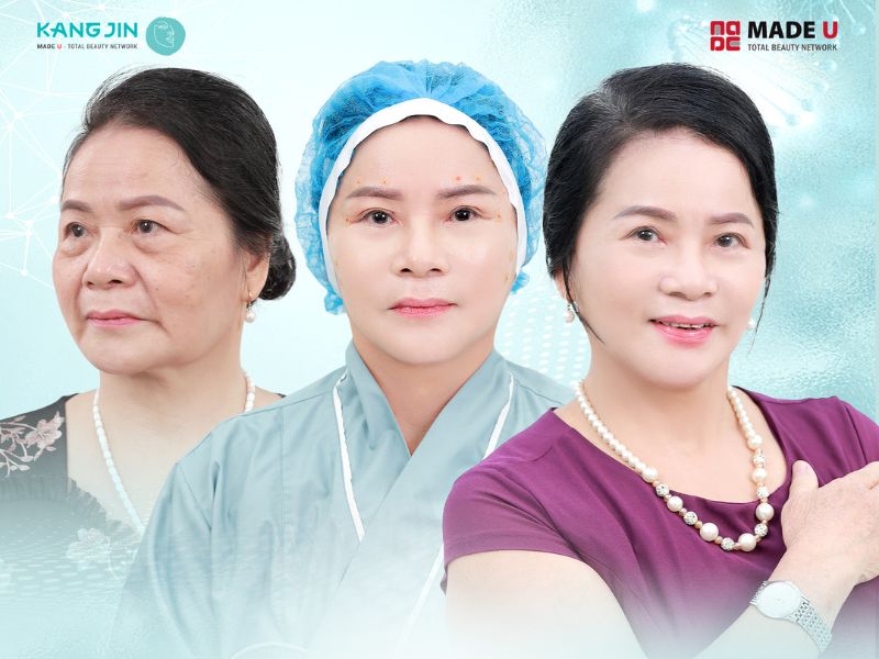 Tìm hiểu chi phí nâng cơ mặt 2024 và cách tối ưu hóa chi phí