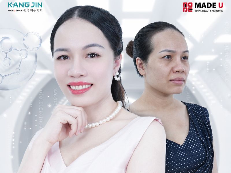 Hình ảnh khách hàng sau khi trẻ hóa da bằng KangJin Maxcollagen Diamond Siêu Vi Điểm 