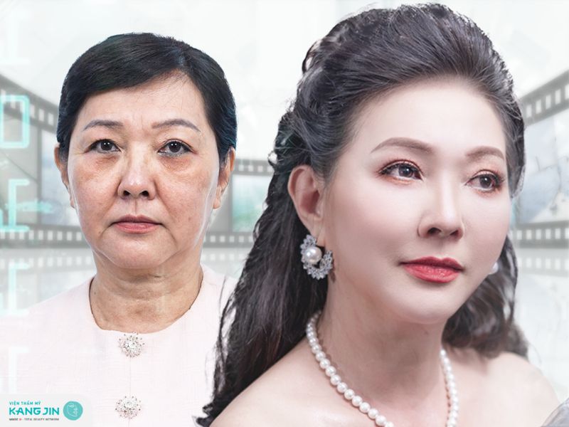 bảng giá căng da mặt chảy xệ