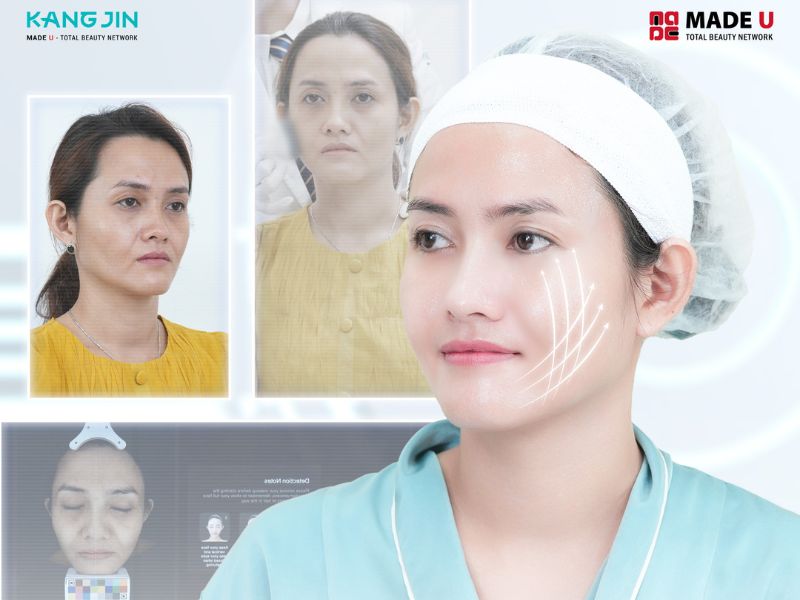 Hình ảnh khách hàng sau khi căng da mặt tại Viện thẩm mỹ KangJin 