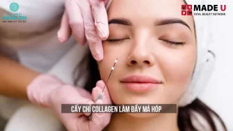 Cấy Chỉ Collagen Làm Đầy Má Hóp Là Gì và Giá Bao Nhiêu?