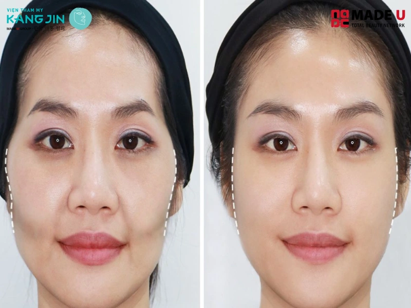 Gò má cao hay còn được gọi là lưỡng quyền cao do xương 2 gò má cao hơn bình thường