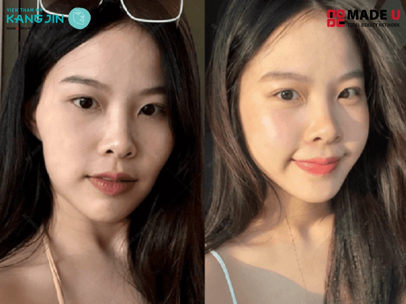 Phẫu thuật gò má cao là 1 phương pháp hiệu quả nhưng chi phí khá cao