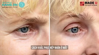 Nguyên Nhân Phương Pháp Khắc Phục Nếp Nhăn ở Mắt Hiệu Quả