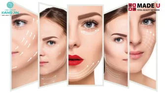 Căng chỉ collagen bao lâu trở lại bình thường? Ưu nhược điểm của phương pháp căng chỉ collagen