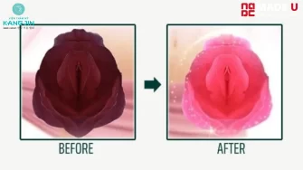 14 Cách Trị Thâm Cô Bé Tại Nhà Hiệu Quả, Đơn Giản và An Toàn