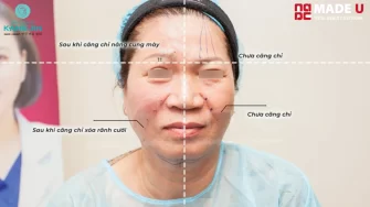 Những biểu hiện sau khi căng chỉ cần chú ý