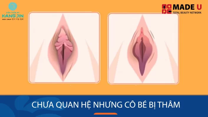 Tại sao vùng kín bị thâm khi chưa quan hệ?