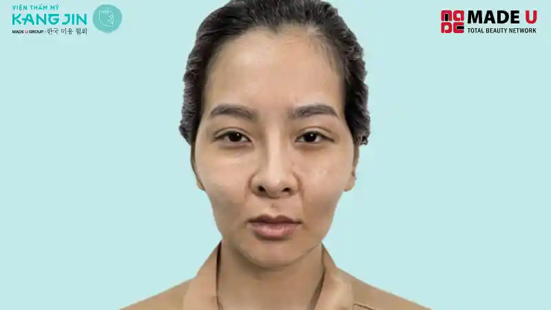 Gò má cao mang tính thẩm mỹ xấu, gây cảm giác già đi trước tuổi