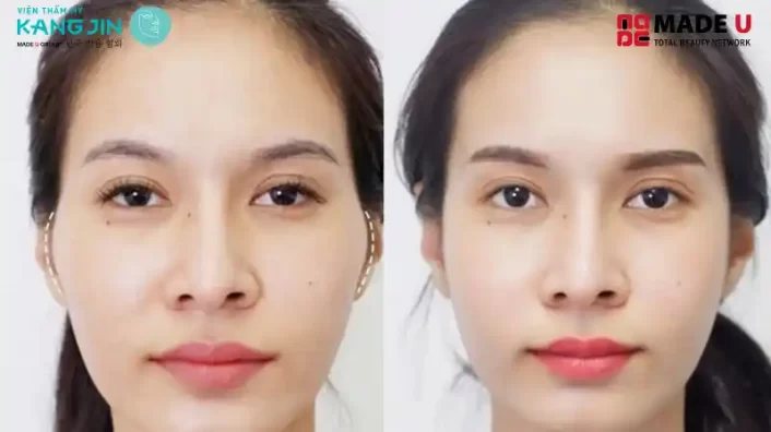 Phẫu Thuật Hạ Gò Má Giá Bao Nhiêu?